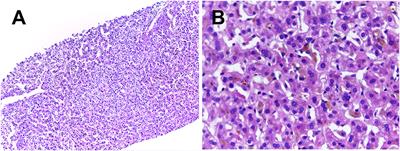 Case Report: A Novel Homozygous Variant Identified in a Chinese Patient With Benign Recurrent Intrahepatic Cholestasis-Type 1